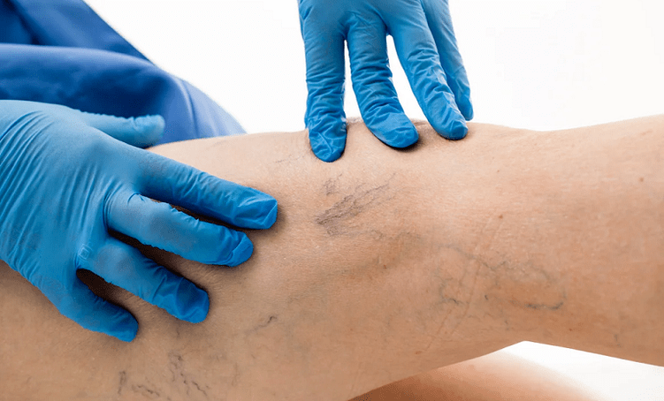 A malla vascular nas pernas é un signo de varices