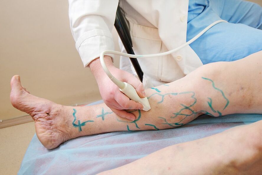 Preparación para miniflebectomía marcado nos perforadores da perna inferior, realizando ecografía